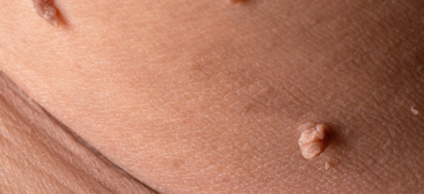 Папилломы на животе: причины и лечение