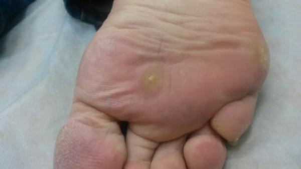 Особенности лечения подошвенных папиллом