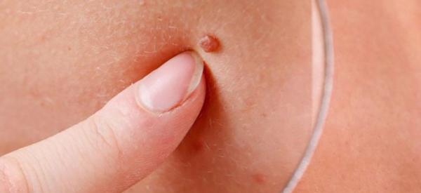 Папилломы на колене: причины и лечение