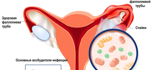 Сальпингит: причины, симптомы, диагностика, лечение