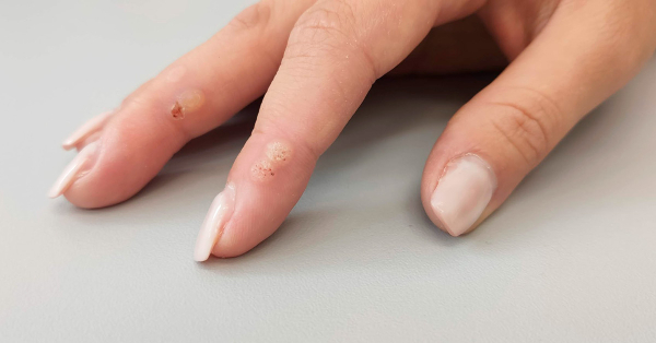 Не заживает рана после удаления бородавки