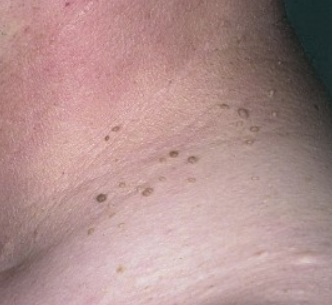 Как вылечить вульгарные папилломы?