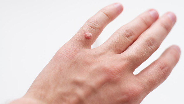 Вирусные бородавки на руках: причины и лечение