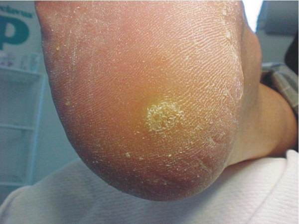 Лечение бородавок на пятке народными средствами в домашних условиях