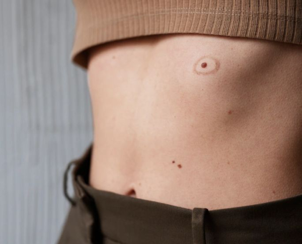 Основные отличия полипов от папиллом