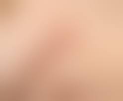 Что делать, если опухла бородавка