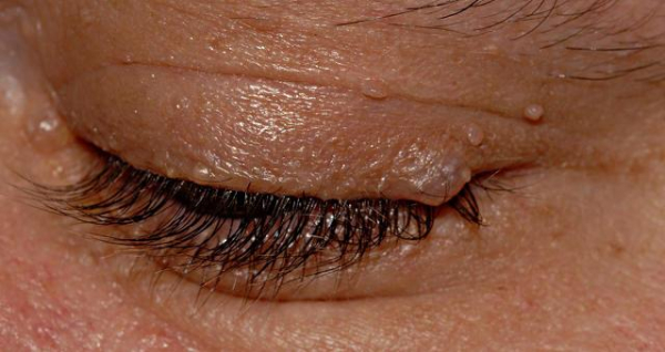 Папиллома верхнего века: причины и лечение