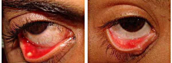 Мейбомит: причины, симптомы, лечение, профилактика