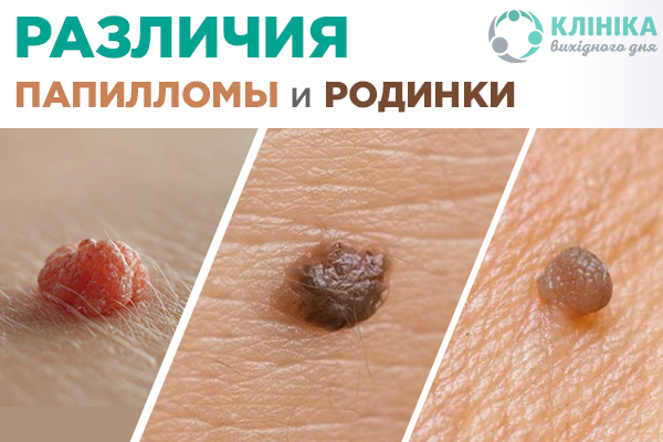 Причины и лечение множественных папиллом