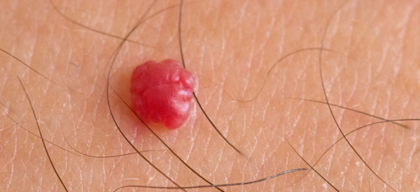 Воспалилась папиллома, что делать?