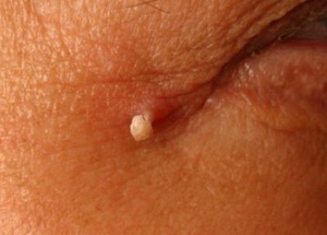 Можно ли прижечь папиллому зеленкой?