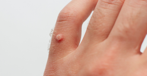 Какой врач лечит бородавки на руках?