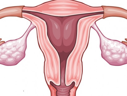 Оофорит или воспаление яичников: причины, симптомы, лечение