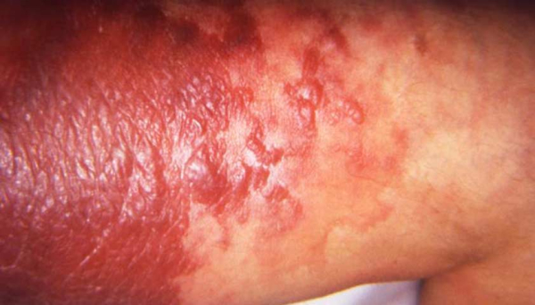 Рожа: причины, симптомы, лечение и осложнения