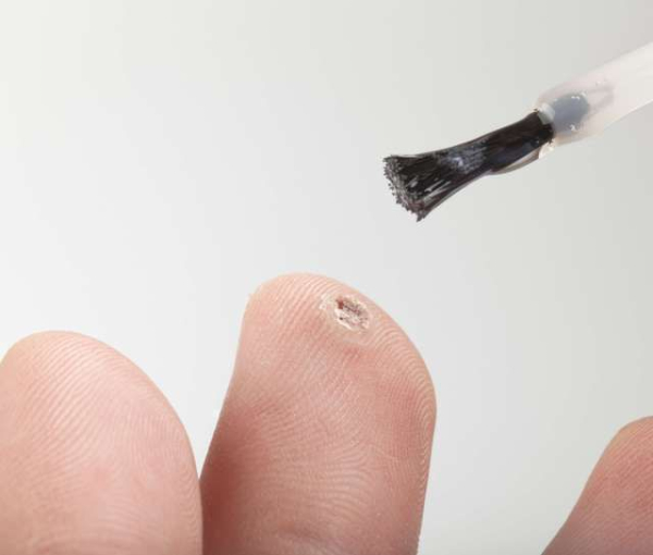 Что делать, если лопнул пузырь от бородавки