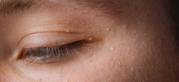 Бородавка на веке у ребенка