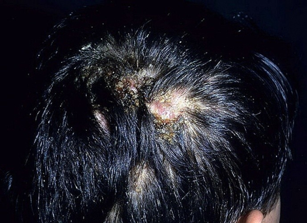 Подрывающий фолликулит Гофмана: причины, симптомы и лечение