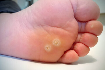 У ребенка почернела бородавка, что делать