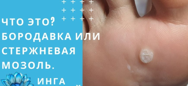 Лечение подошвенной бородавки лаком для ногтей