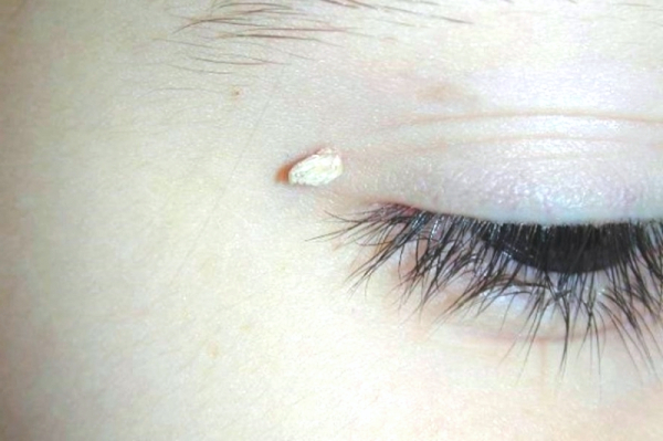 Бородавка на попе у ребенка: причины, симптомы и лечение