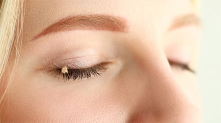 Папиллома верхнего века: причины и лечение