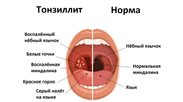 Папилломы в горле у ребенка: причины, симптомы и лечение