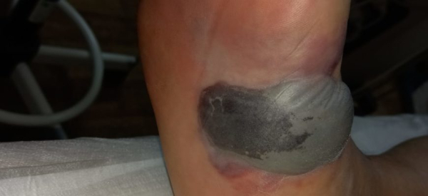 Гангрена: причины, виды, симптомы, лечение