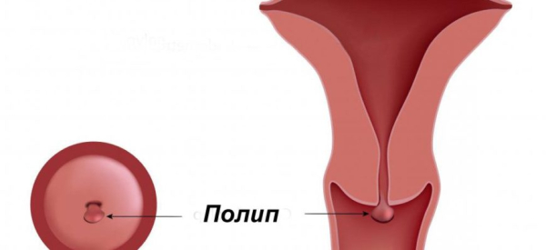 Что такое папиллома цервикального канала и как ее лечить?
