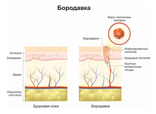Как избавиться от плоских бородавок домашними средствами