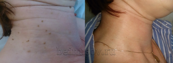 Удаление папиллом радиоволновым методом или лазером &mdash; что лучше