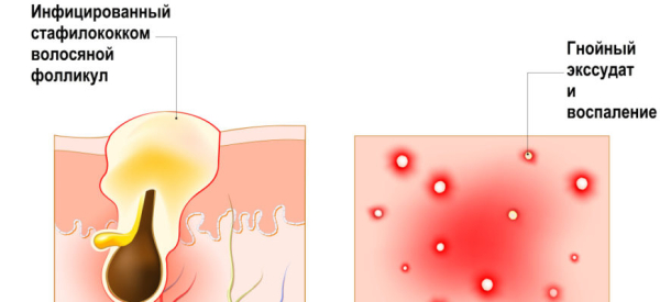 Причины и лечение фолликулита после бритья
