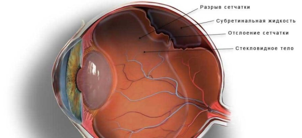 Отслоение сетчатки: причины, симптомы, лечение, профилактика