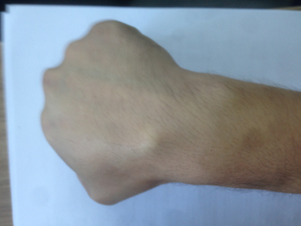 Гигрома у ребенка: причины, симптомы, лечение