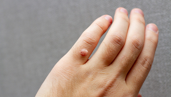 Причины и лечение множественных папиллом