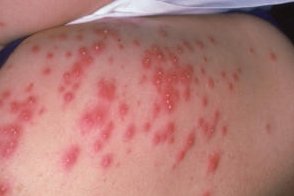 Фолликулит: передается ли он от человека к человеку?