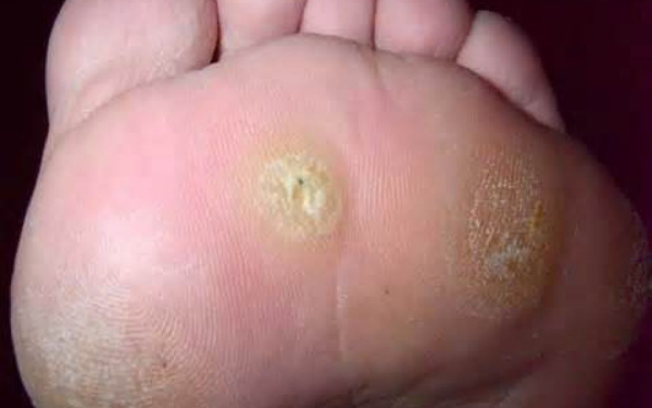 Подошвенная бородавка при беременности