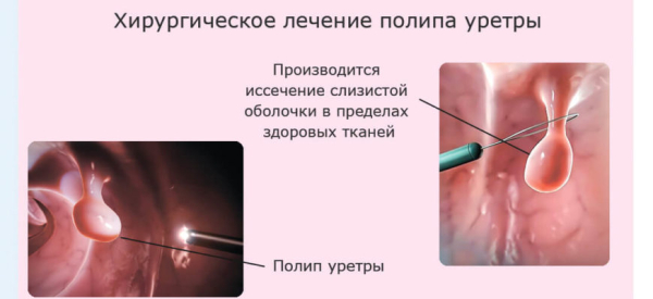 Папиллома в уретре: причины, симптомы, лечение