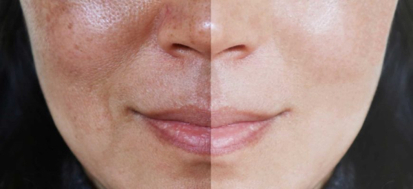 Мелазма: причины, симптомы, лечение, профилактика