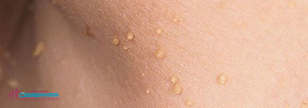 Плоские папилломы: симптомы, причины, лечение и профилактика