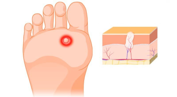 Лечение бородавок на пятке народными средствами в домашних условиях