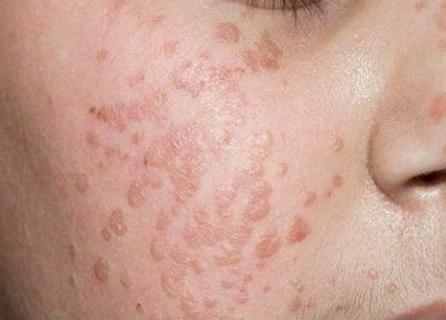 Плоские папилломы на теле: причины и лечение