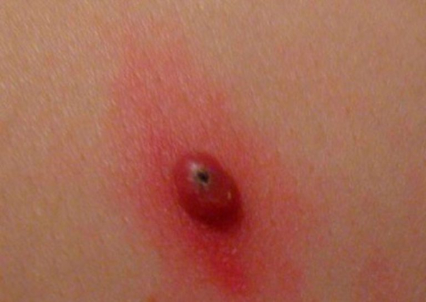 Что делать, если почернела папиллома?