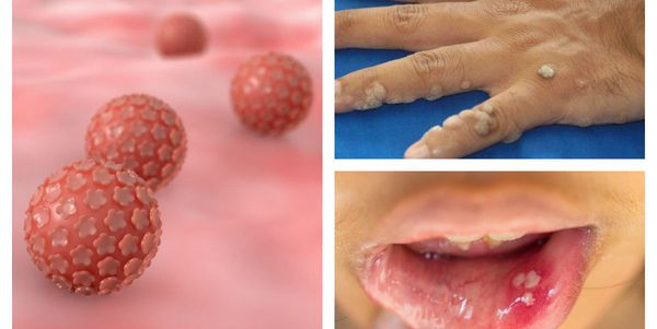 Опасность вируса папилломы человека 56 типа