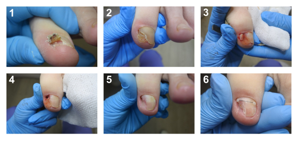 Как избавиться от бородавок на ногтях ног