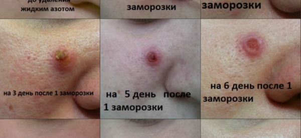 Прижигание папиллом жидким азотом: последствия и отзывы