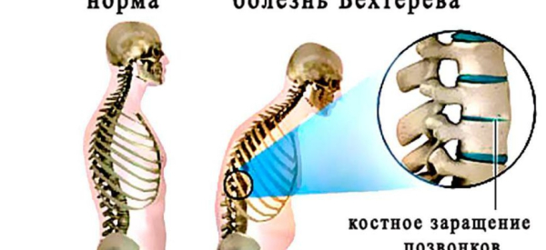 Спондилит: причины, симптомы и лечение воспаления позвоночника