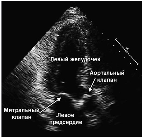 Болезнь Уиппла: причины, симптомы, диагностика и лечение
