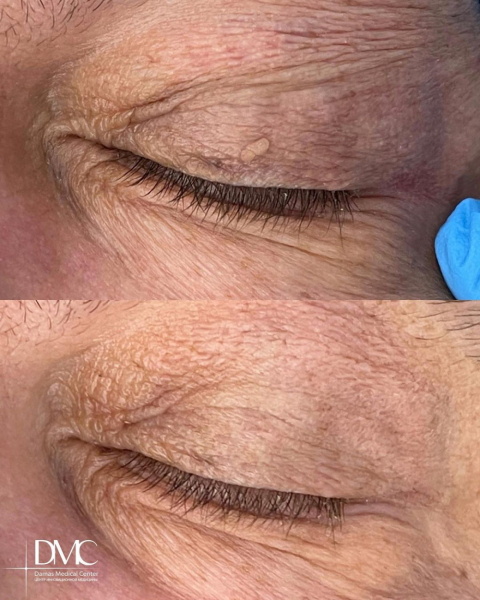 Как избавиться от бородавки на верхнем веке?