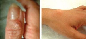 Гигрома у ребенка: причины, симптомы, лечение