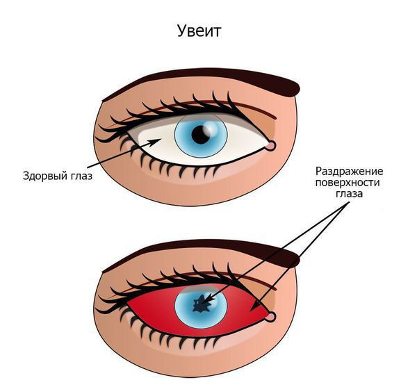 Отслоение сетчатки: причины, симптомы, лечение, профилактика
